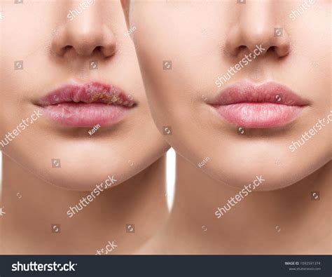 Female Dry Lips With Herpes Cold Sore Stock Photo Image Of Treatment