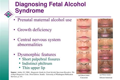 Fetal Alcohol Spectrum Disorder Jama The Jama Network Fetal Alcohol Spectrum Disorder Jama The Jama Network