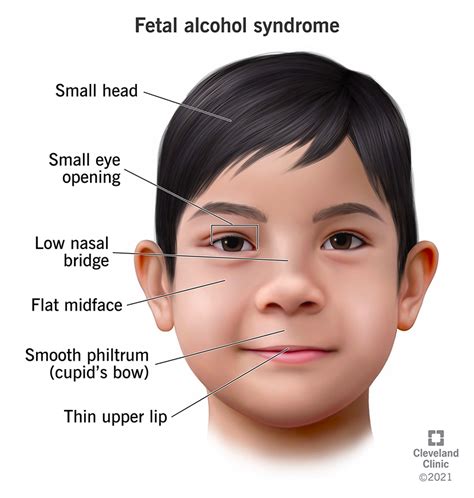 Fetal Alcohol Syndrome Facial Features