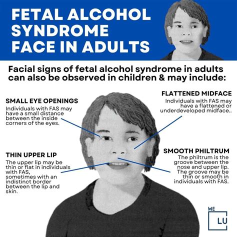 Fetal Alcohol Syndrome Fetal Alcohol Fetal Alcohol Syndrome Foetal Fetal Alcohol Syndrome Fetal Alcohol Fetal Alcohol Syndrome Foetal