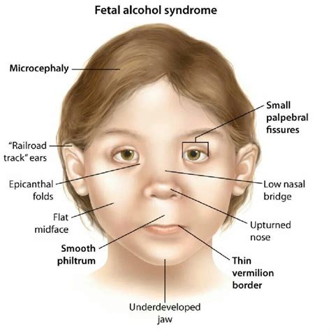Fetal Alcohol Syndrome In Adults Symptoms Facial Signs Fetal Alcohol Syndrome In Adults Symptoms Facial Signs