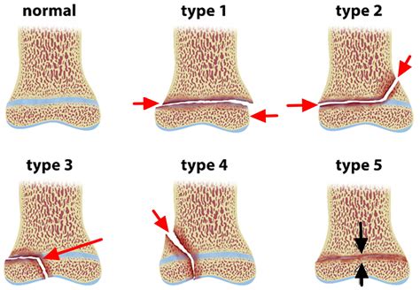Figure 4 From Salter Harris Type Ii Fracture Of The Femoral Bone In A