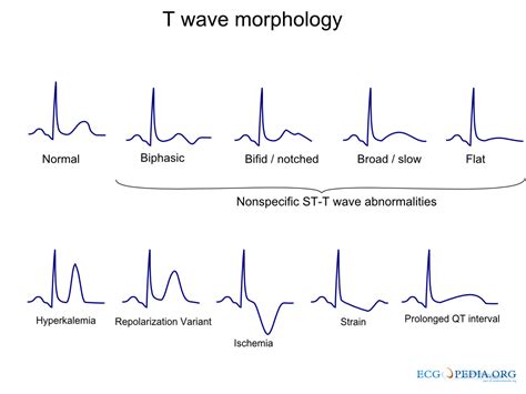 File T Wave Morphology Png Ecgpedia