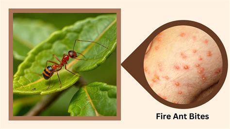 Fire Ant Bites Images