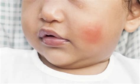 Fire Ant Bites On Baby