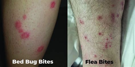 Flea Bites Vs Bed Bug Bites Different Symptoms Treatments Baysection