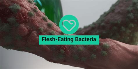 Flesh Eating Bacteria Symptoms And Causes Upmc