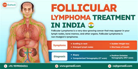 5 Ways Follicular Lymphoma