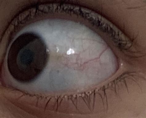 Gray Spot In Your Eye: What It Could Mean, 51% Off