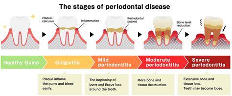 Gum Disease Plano Tx Gingivitis Periodontal Disease Dallas Gum Disease Plano Tx Gingivitis Periodontal Disease Dallas