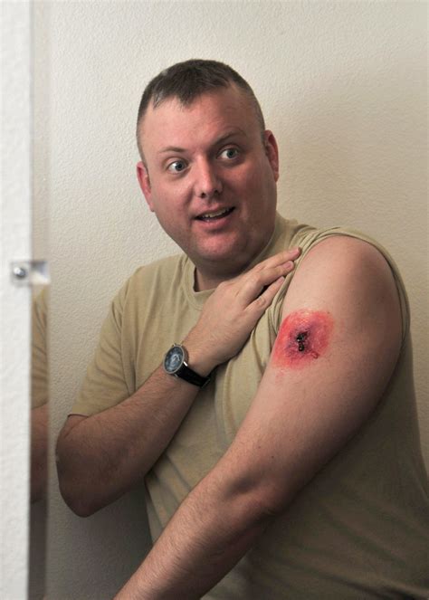 Gunshot Wound To The Arm Trauma Transmetacarpal Gunshot Wound