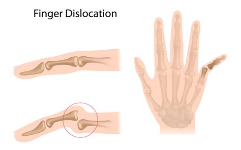 Hand And Finger Dislocations Causes Symptoms And Treatment