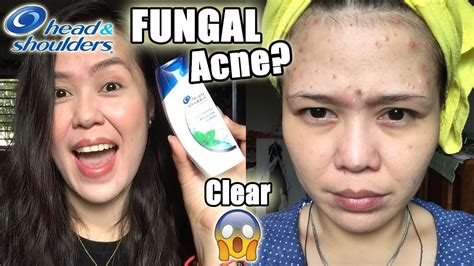 Head And Shoulders Acne Before And After Results Youtube