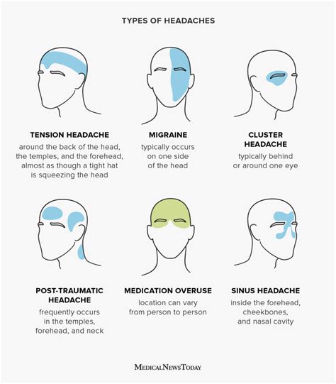 Headache Chart Types By Symptoms Location And Causes