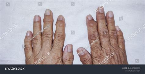 Heberden39s Nodes Causes Symptoms And Treatment Swollen Lymph Nodes