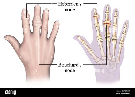 Heberden's and Bouchard's Nodes: Causes, Symptoms, and Treatment Options
