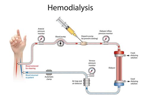 Hemodialysis What To Expect Michigan Kidney Consultants P C