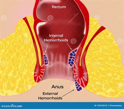 Hemorrhoid Illustration Of Unhealthy Lower Rectum With Inflamed Hemorrhoid Illustration Of Unhealthy Lower Rectum With Inflamed