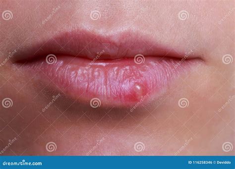 Herpes On Lips Pictures