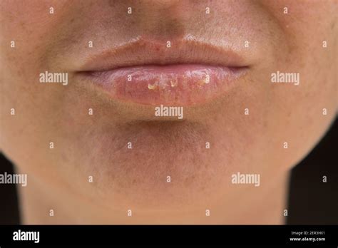 Herpes Simplex Female Hi Res Stock Photography And Images Alamy