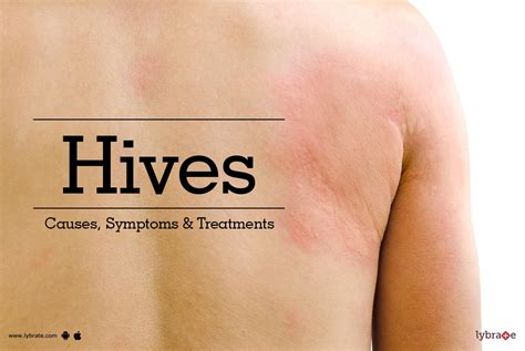 Hives Symptoms Causes Treatment