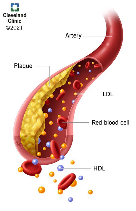 Hld Hyperlipidemia
