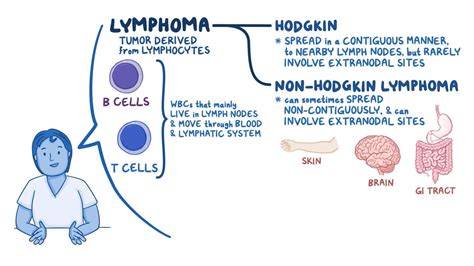 Hodgkin S Vs Non Hodgkin S Lymphoma Chart A Visual Reference Of Charts