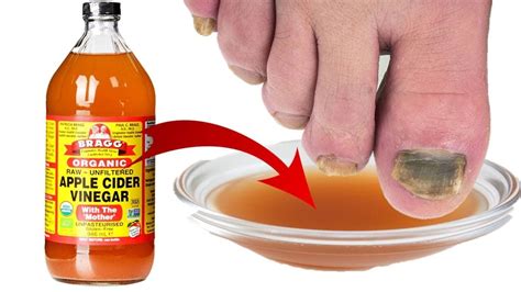 Home Remedy For Toenail Fungus Vinegar Toenail Fungus Treatment Home Remedy For Toenail Fungus Vinegar Toenail Fungus Treatment
