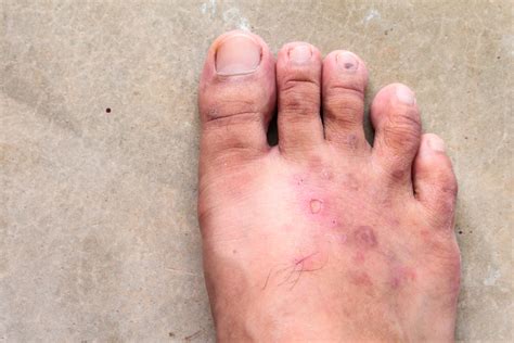 How Can You Effectively Manage Psoriasis On Feet Modern Foot Ankle