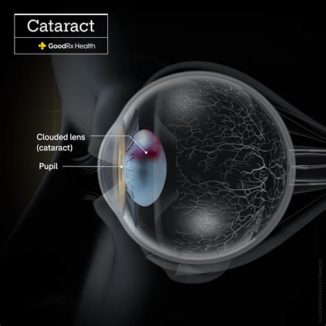 How Do Cataracts Affect Vision Invision Eye Care Ophthalmologists