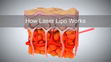 How Laser Lipo Works To Release Fat And Reduce Cellulite Youtube How Laser Lipo Works To Release Fat And Reduce Cellulite Youtube