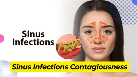 How Long Are Sinus Infections Contagious A Complete Guide