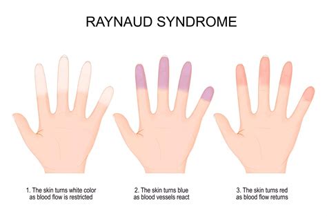 How Raynaud S Phenomenon Affects Your Fingers And Toes What Is This