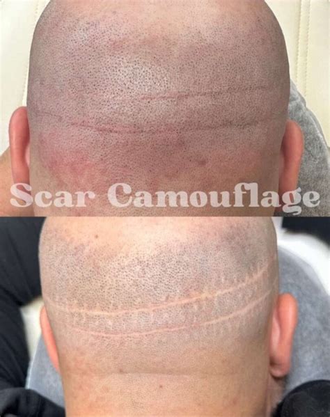 How Smp Conceals Hair Transplant Scars And Restores Confidence Daela How Smp Conceals Hair Transplant Scars And Restores Confidence Daela