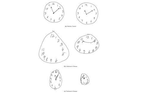 How The Clock Drawing Test Screens For Dementia