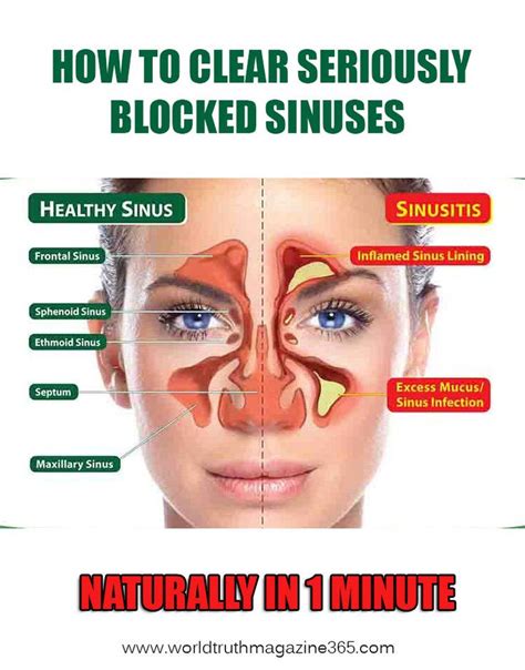 How To Clear Seriously Blocked Sinuses Naturally In 1 Minute With This