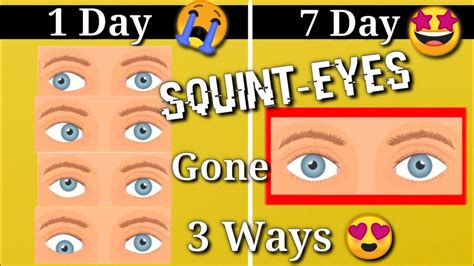 How To Cure A Squinted Eye With Natural Exercises Quora