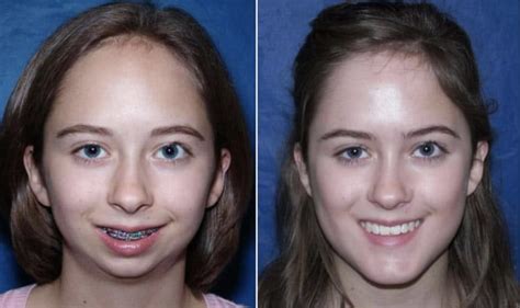 How To Fix Mouth Breather Face Adenoid Face Does Mouth Breathing