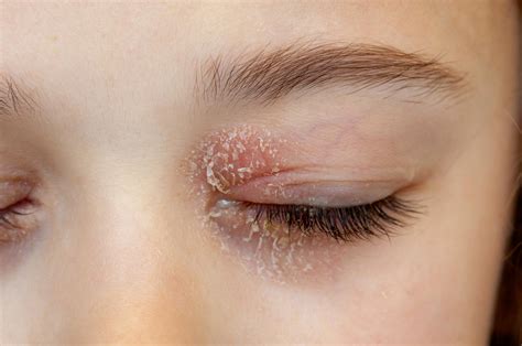 How To Get Rid Of Eyelid Dermatitis In Few Days Yummylooks