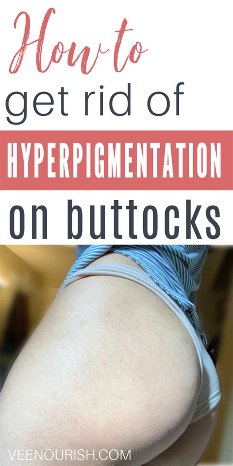 How To Get Rid Of Hyperpigmentation On Buttocks The Everyday Blogger