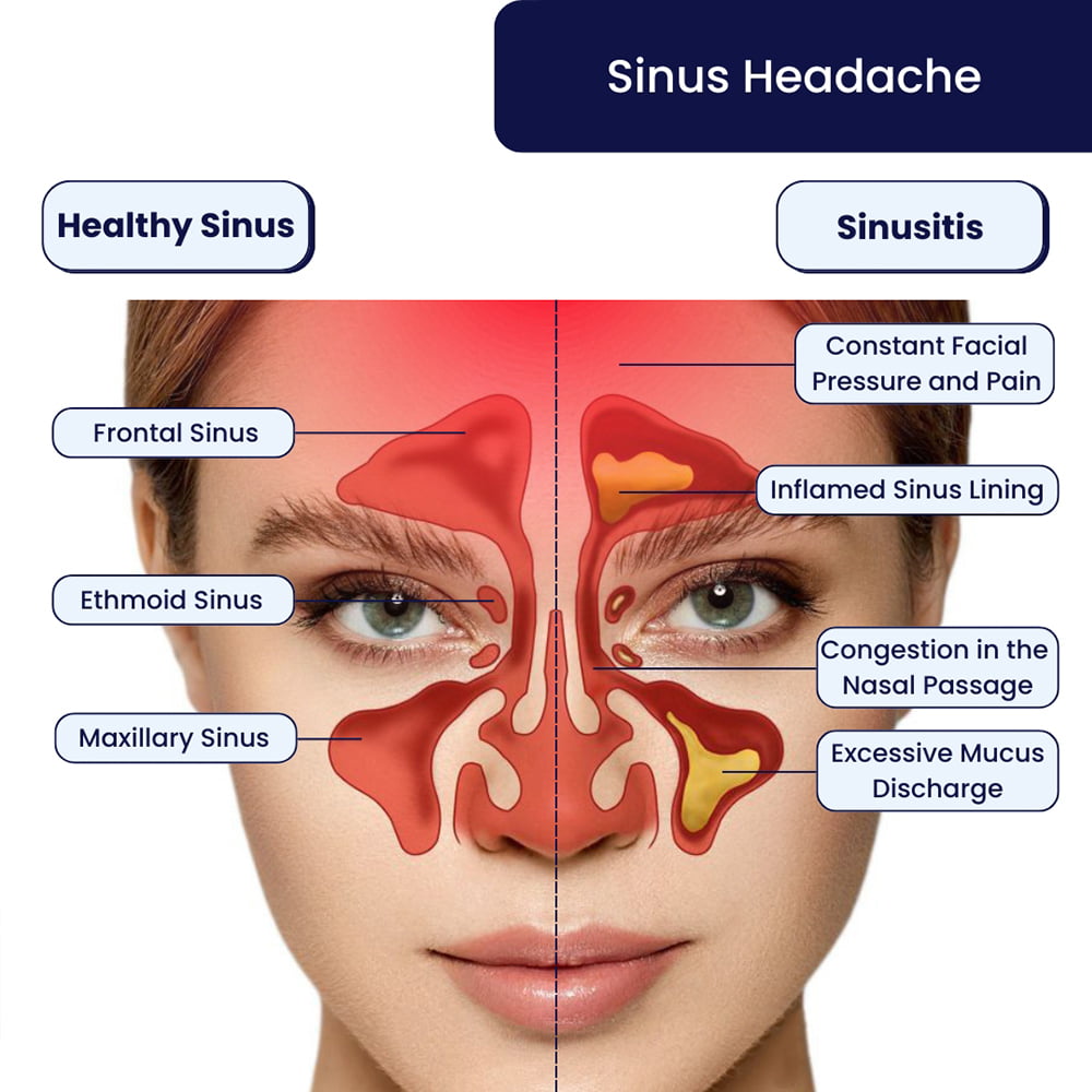 How To Help Sinus Headaches Classeconomy3