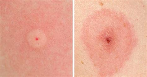 How To Identify Bug Bites A Helpful Guide Homemaking Com