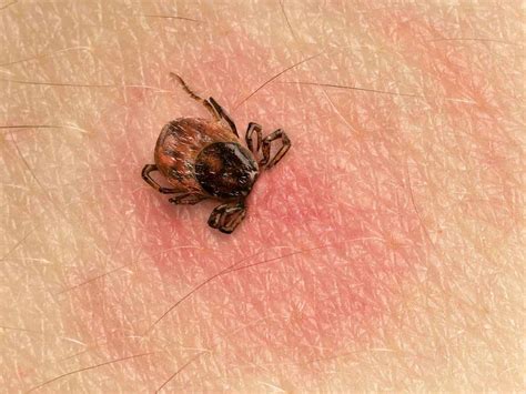 How To Identify Tick Bites Tick Bite Pictures Igenex Tick Talk