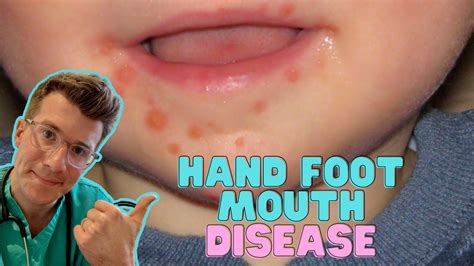 How To Recognise Treat Hand Foot And Mouth Disease Coxsackievirus How To Recognise Treat Hand Foot And Mouth Disease Coxsackievirus