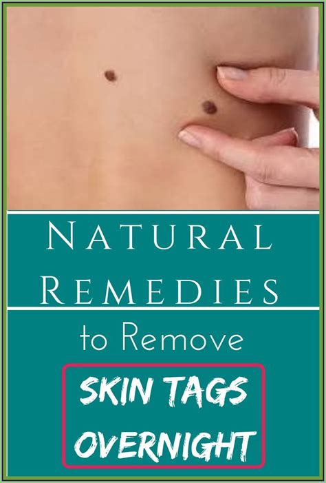 How To Remove Skin Tag Overnight How To Remove Skin Tag Overnight