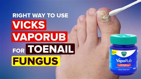 How To Use Vicks For Toe Fungus Vicks Vaporub Fungus Toenail
