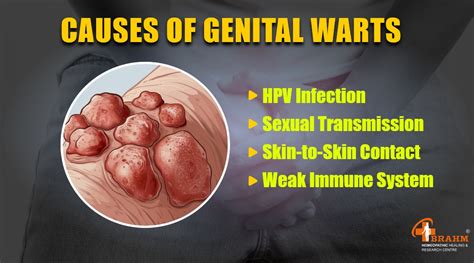 Hpv Symptoms Warts Genital Warts Cancer