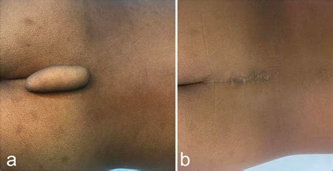Human Tail In A Newborn Sciencedirect