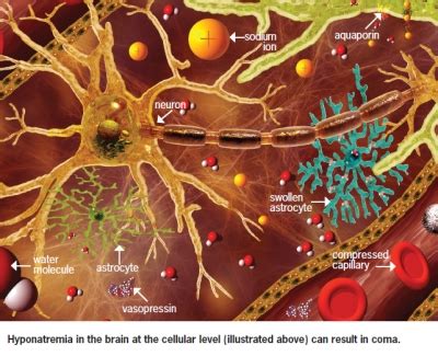 Hyponatremia An Update On The Management Of Siadh Renal And Urology News Hyponatremia An Update On The Management Of Siadh Renal And Urology News