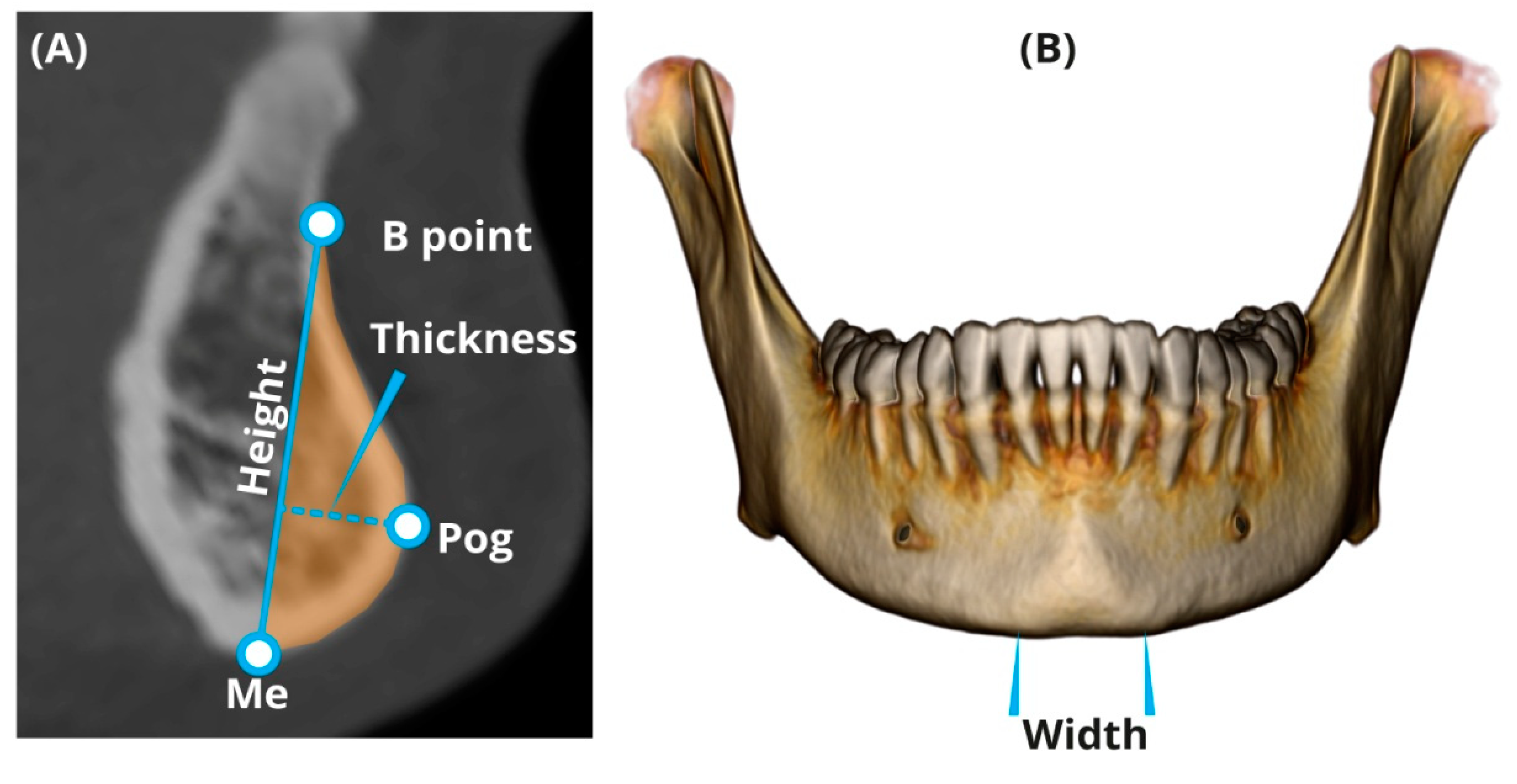 Ijerph Free Full Text Variation In Chin And Mandibular Symphysis Ijerph Free Full Text Variation In Chin And Mandibular Symphysis